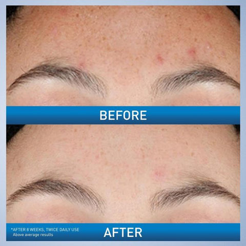 Cerave Resurfacing Retinol Serum For Post Acne Marks, Brightening Serum, Post Acne Skin Barrier Repair – 30ml